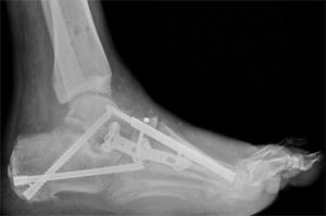 Charcot Reconstruction - Brick Foot and Ankle Center